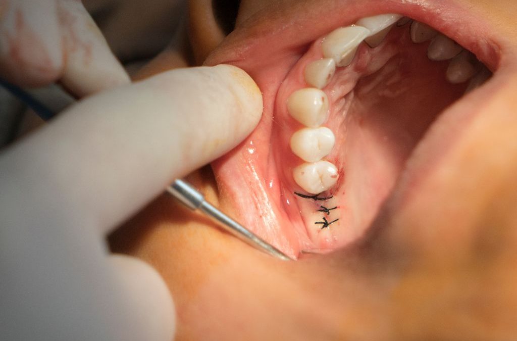 cirugías dentales