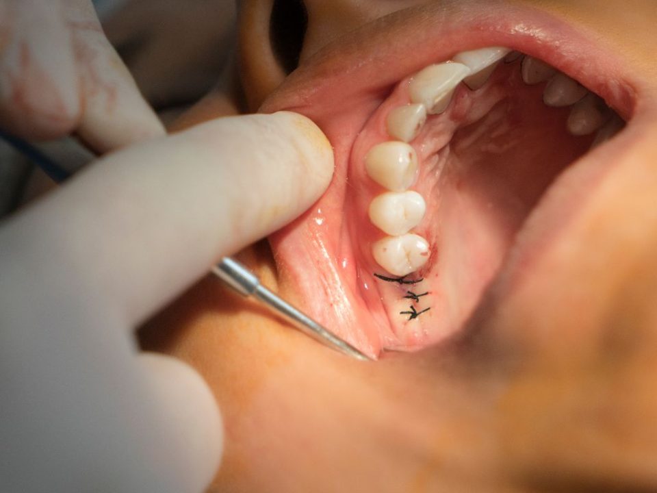 cirugías dentales