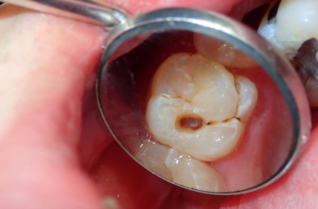 Cómo prevenir las caries