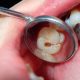 Cómo prevenir las caries