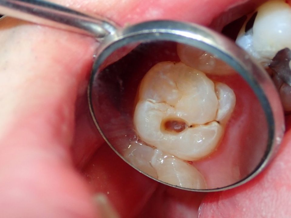 Cómo prevenir las caries