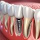 qué es un implante dental