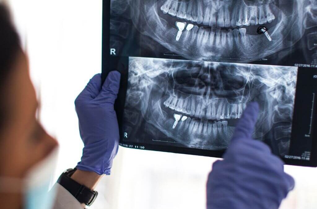diseño CAD CAM dental