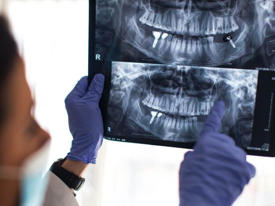 diseño CAD CAM dental