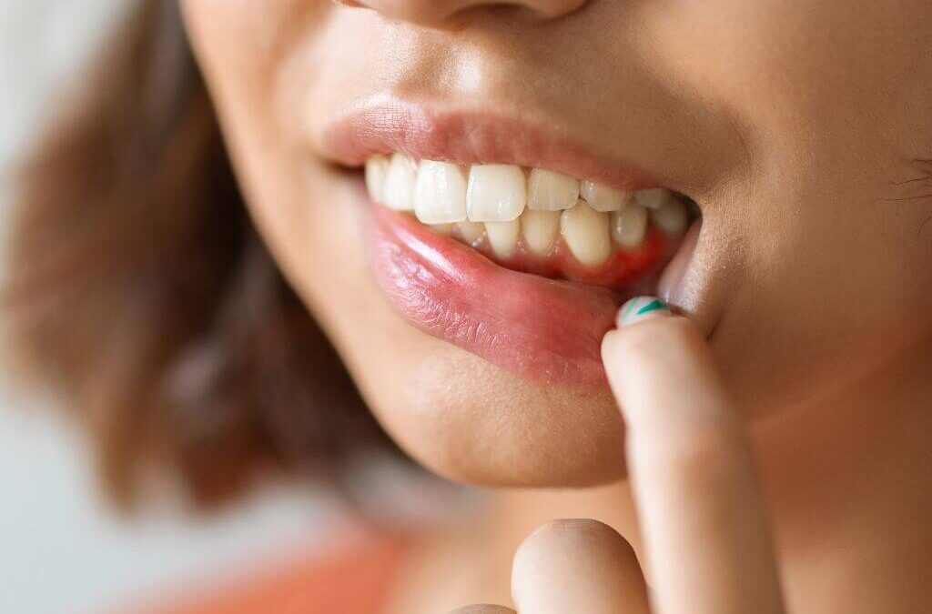 diferencia entre gingivitis y periodontitis