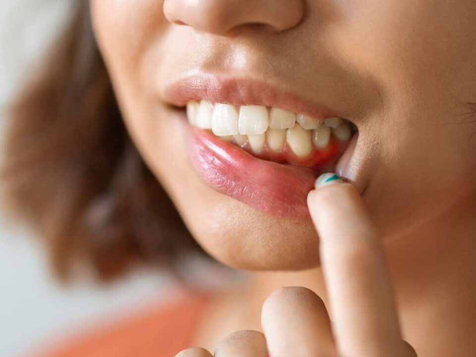 diferencia entre gingivitis y periodontitis