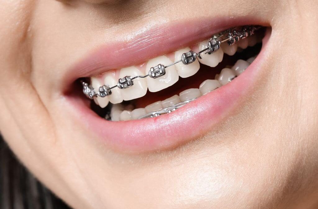 ortodoncia con implantes