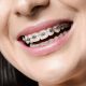 ortodoncia con implantes