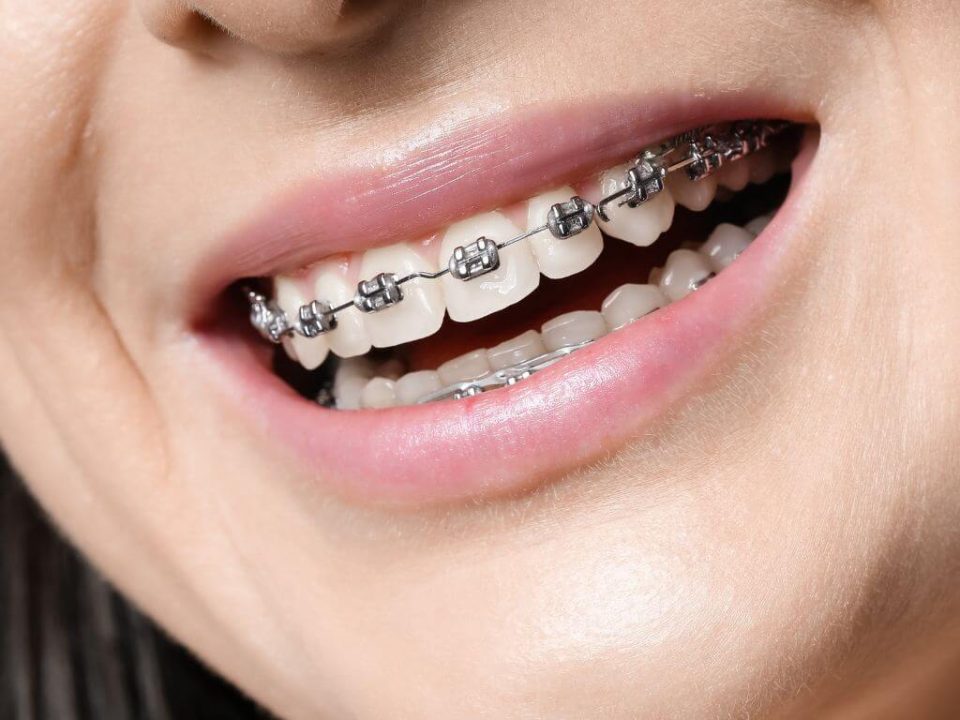ortodoncia con implantes