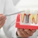cómo se pone un implante dental