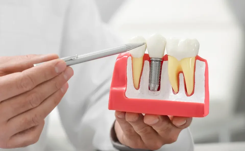 cómo se pone un implante dental