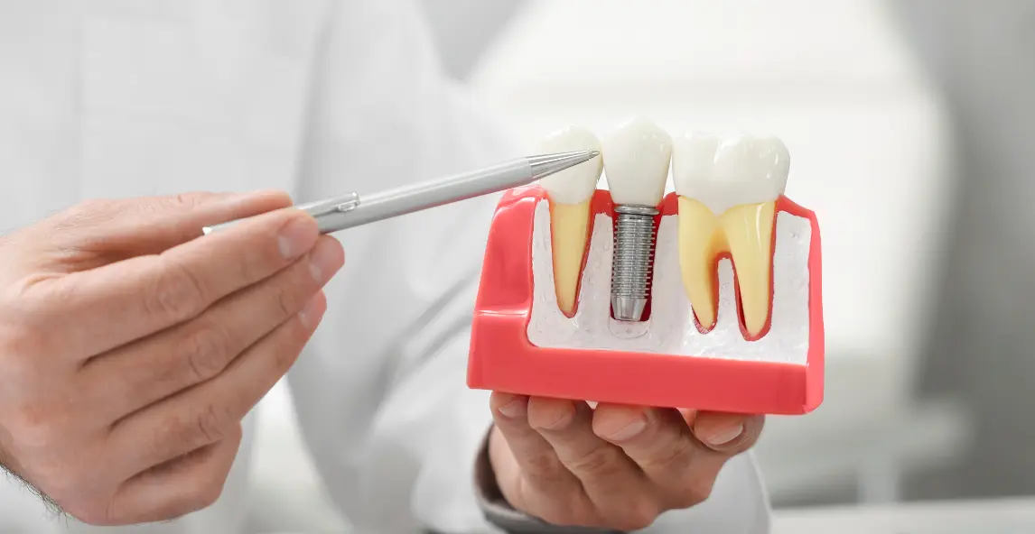 cómo se pone un implante dental