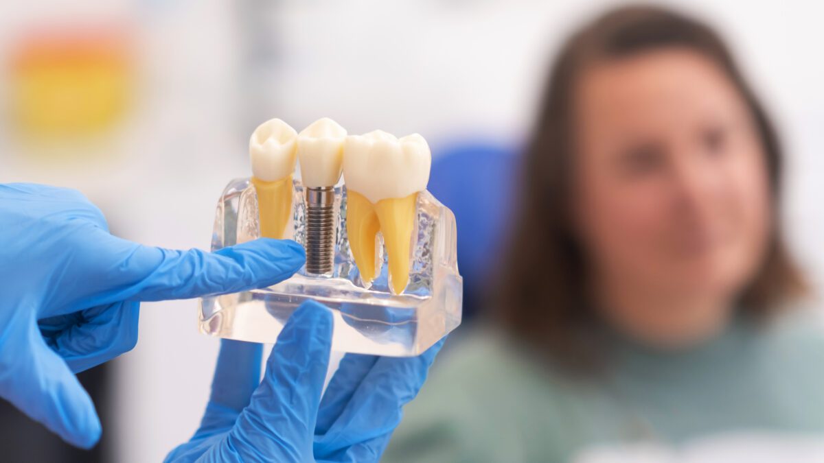 Alternativas al implante dental