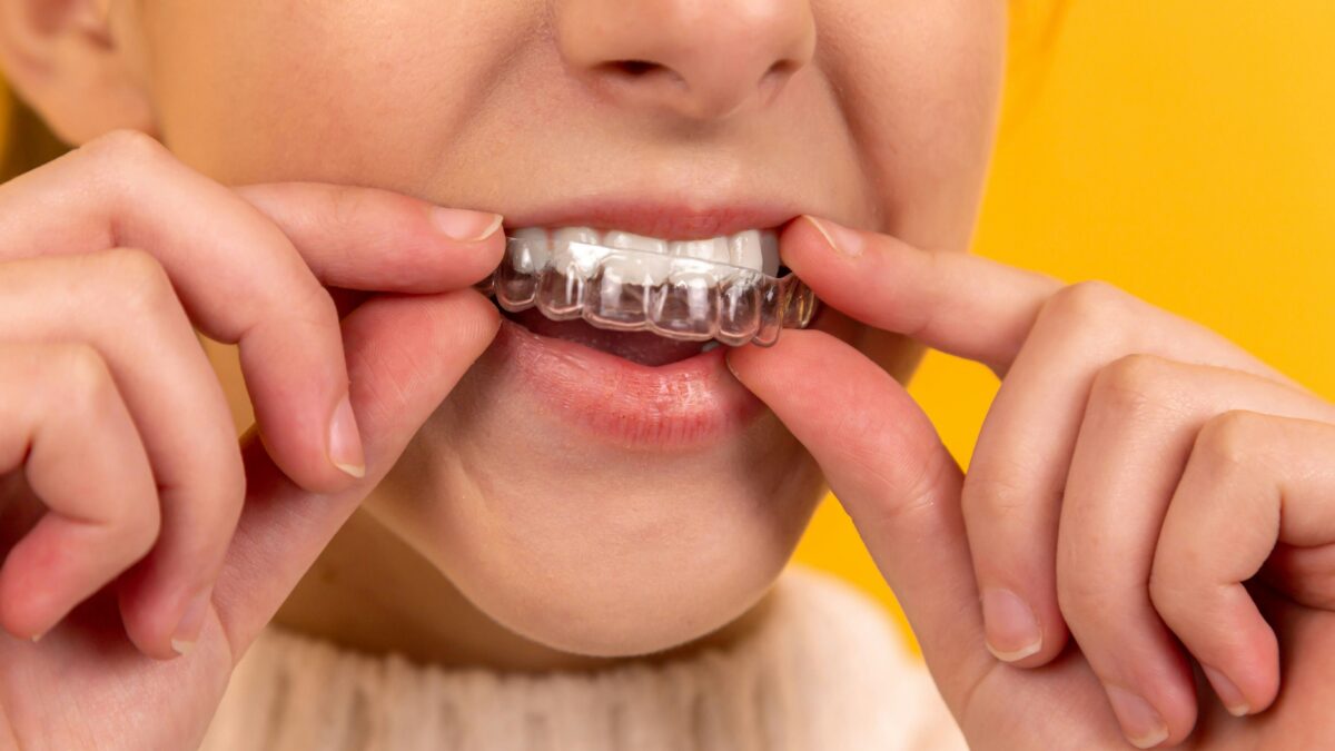 Cómo limpiar la férula dental