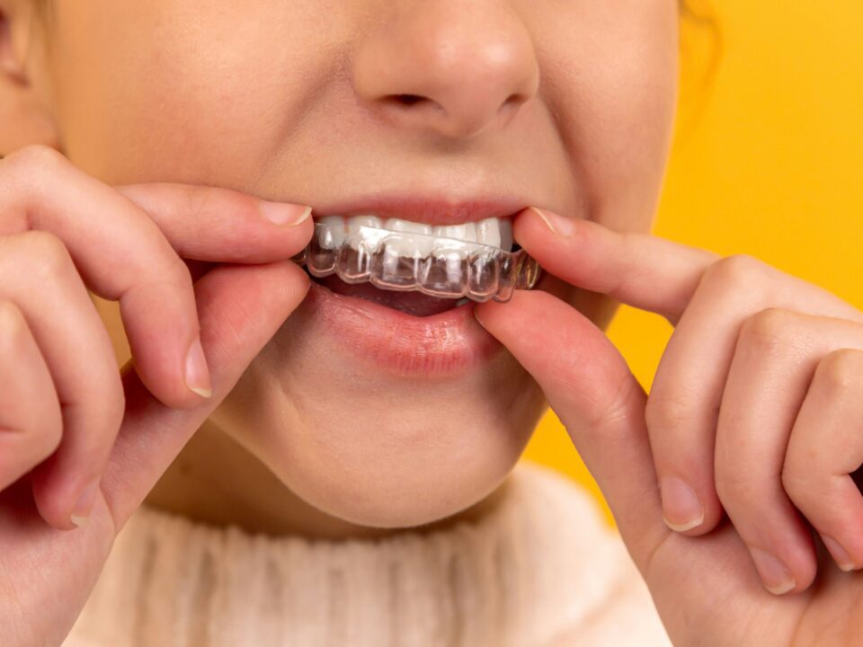 Cómo limpiar la férula dental