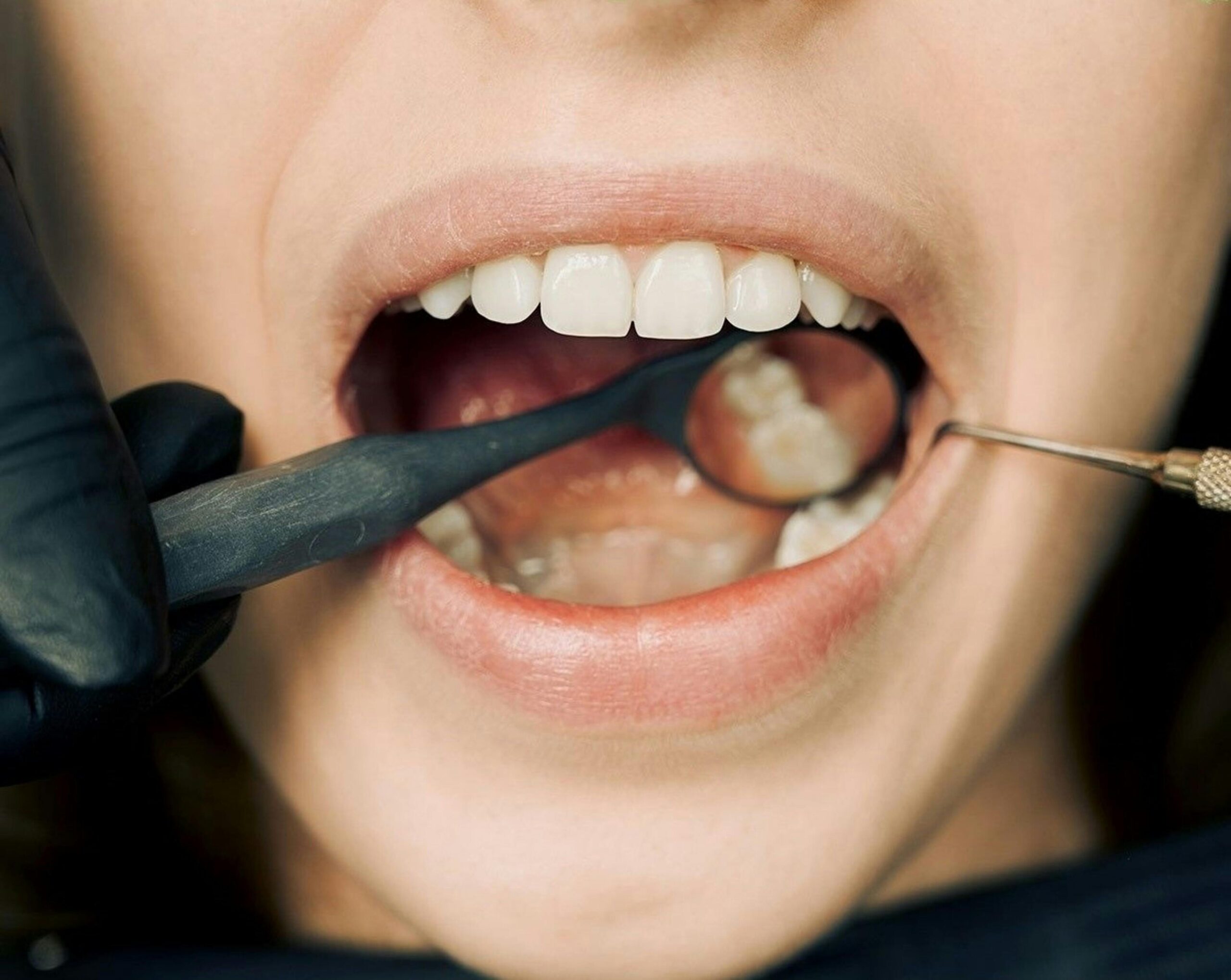 Qué es la regeneración ósea dental